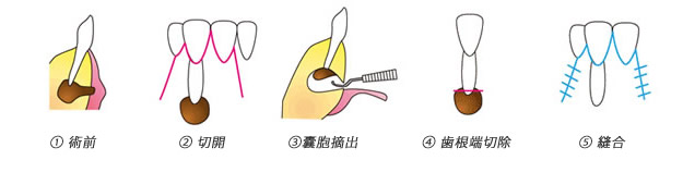 嚢胞摘出＆歯根端切除術1