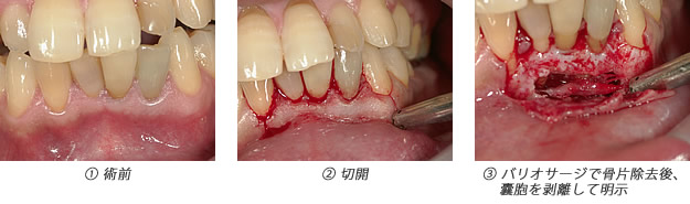 嚢胞摘出＆歯根端切除術2