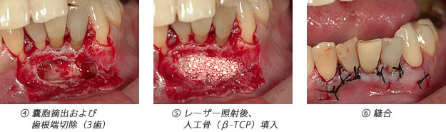 嚢胞摘出＆歯根端切除術3