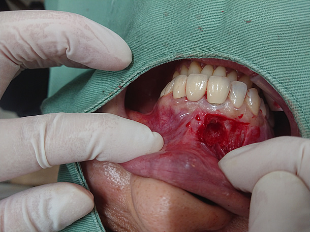 嚢胞摘出＆歯根端切除術