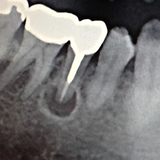 歯根嚢胞2